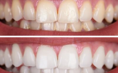 Before & After Smile Design Transformations in Miami, FL