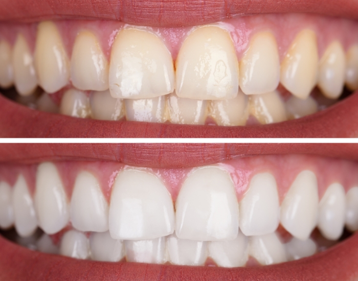 Before & After Smile Design Transformations in Miami, FL