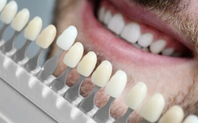 Porcelain Veneers: Pros and Cons – What You Should Know