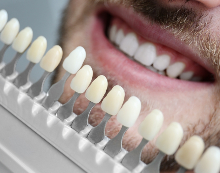 Porcelain Veneers: Pros and Cons – What You Should Know