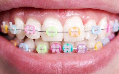 Braces Colors: Blue and Pink – Choosing the Perfect Style for Your Smile