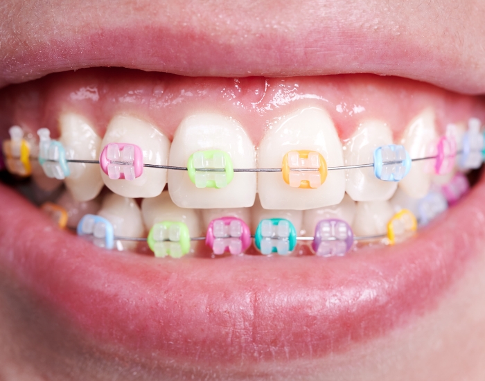 Braces Colors: Blue and Pink – Choosing the Perfect Style for Your Smile