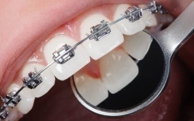 What Can You Eat with Braces (Foods You Can Enjoy & Tips for Comfort)