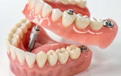 Full Mouth Dental Implants: What You Need to Know